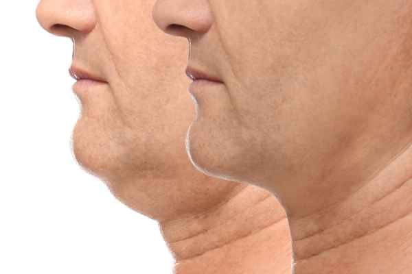 HIFU - Breakthrough in Anti - ageing 2 hifu results Hertfordshire
