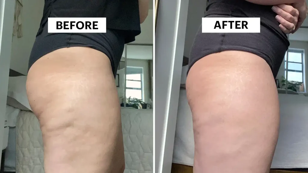 Do Toning Exercise Hertfordshire Really Tackle Cellulite?