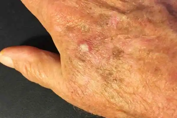 Image of Actinic keratoses Hertfordshire on a person hand