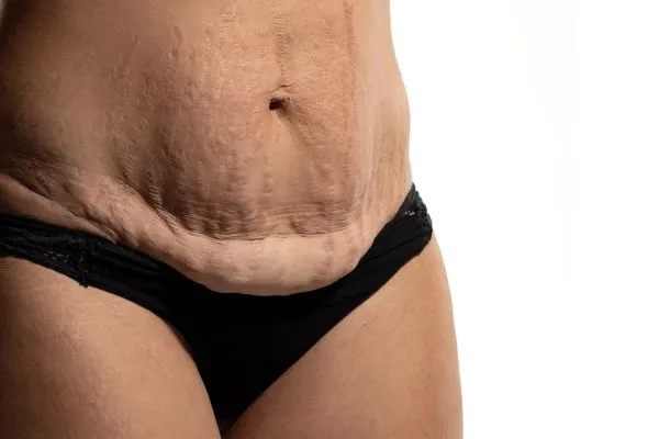 The science behind skin tightening Hertfordshire picture of a woman's sagging skin on the stomach
